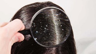  Dandruff  Removing tips:   डैंड्रफ हमेशा के लिए हो जाएगा छूमंतर, इन देसी नुस्खे को करने से तुरंत मिलेगा फायदा, बाल भी होंगे मजबूत 