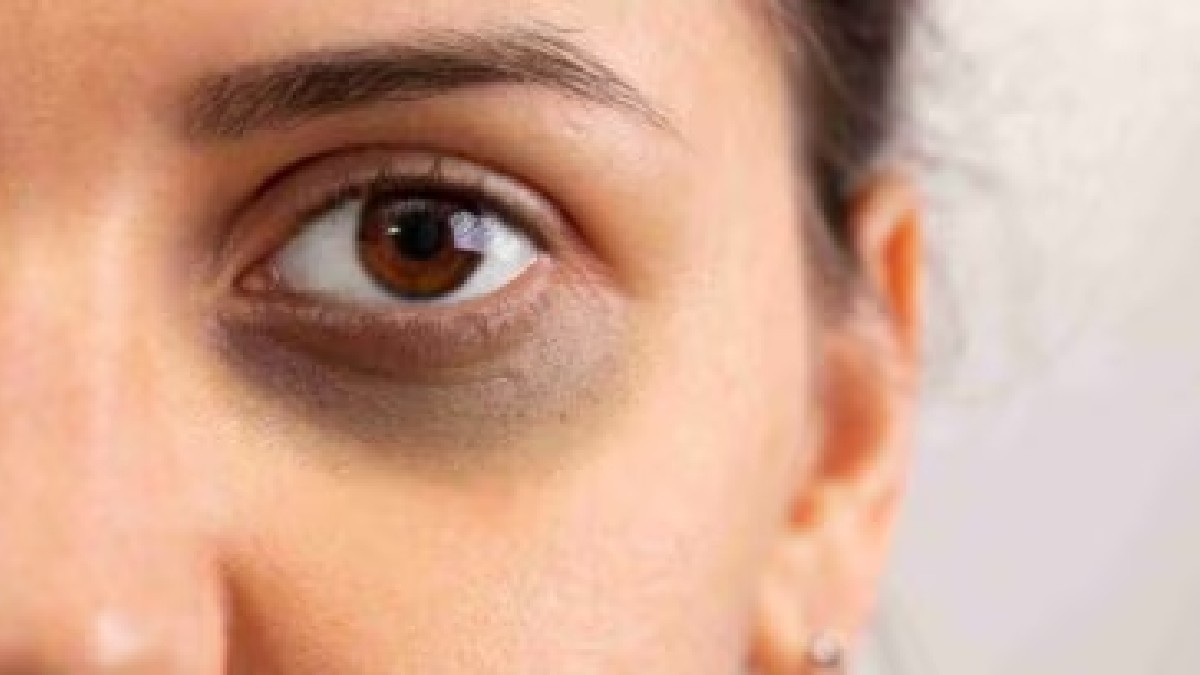  Dark Circle Tips: डार्क सर्कल ने बिगाड़ दी है चेहरे की रंगत, तो आज ही करें ये घरेलू उपाय, फटाफट मिलेगा समस्या से छुटकारा 