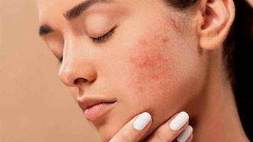 Pimples Ka Gharelu llaj:  प‍िंपल्‍स ने अगर बिगाड़ दी है चेहरे की रंगत, तो अपनाएं ये घरेलू नुस्‍खे, त्वचा हो जाएगी ग्लोइंग और चमकदार