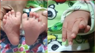 Mircale Baby : बैतूल में जन्मी अनोखी बच्ची ! 20 की जगह हाथ-पैर में है 24 अंगुलिया, डॉक्टर भी हैरान