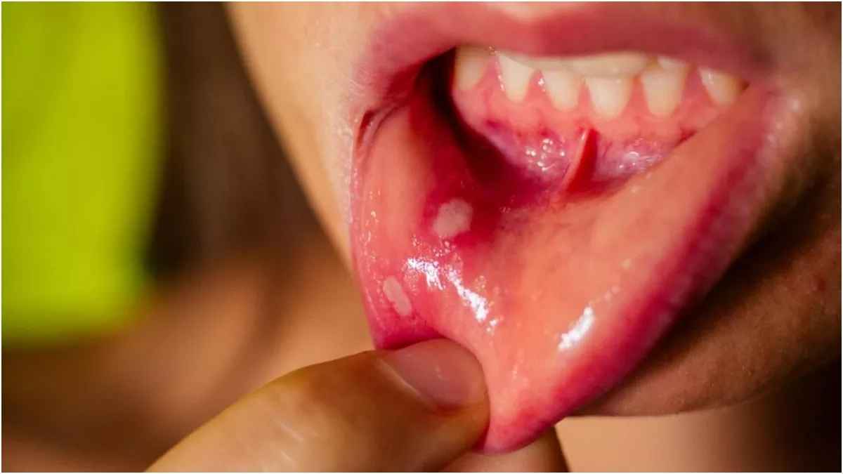 मुंह के छाले से खाना पीना हो गया है मुस्किल, तो तुरंत करें ये घरेलू उपाय, जल्द मिलेगी राहत 